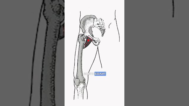 Как определить что болит именно тазобедренный сустав? Как понять что у вас коксартороз?