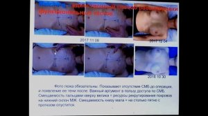 Маммопластика: концепты, разметка, центральный доступ 06/04/19