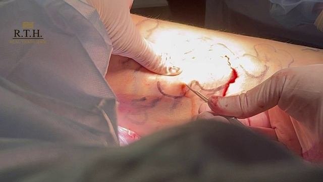 Эндовенозная лазерная коагуляция большой подкожной вены и минифлебэктомия