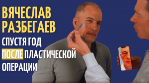 Вячеслав Разбегаев: отзывы о липофилинге и блефаропластике спустя год после операции!