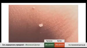 КАК ИЗБАВИТЬСЯ ОТ ПАПИЛЛОМ НА ЛИЦЕ