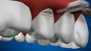 Лечение клиновидного дефекта