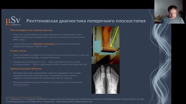 Рентгеновская диагностика плоскостопия взрослых