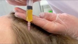 Плазмолифтинг - процедура для роста волос