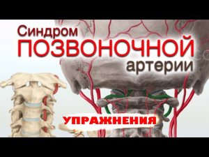 ч.1 Синдром позвоночной артерии - упражнения.