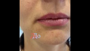 ❣️??Биоревитализация губ❗️