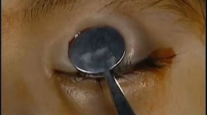 Incision and drainage of upper lid chalazion