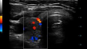 Thyroid CFM