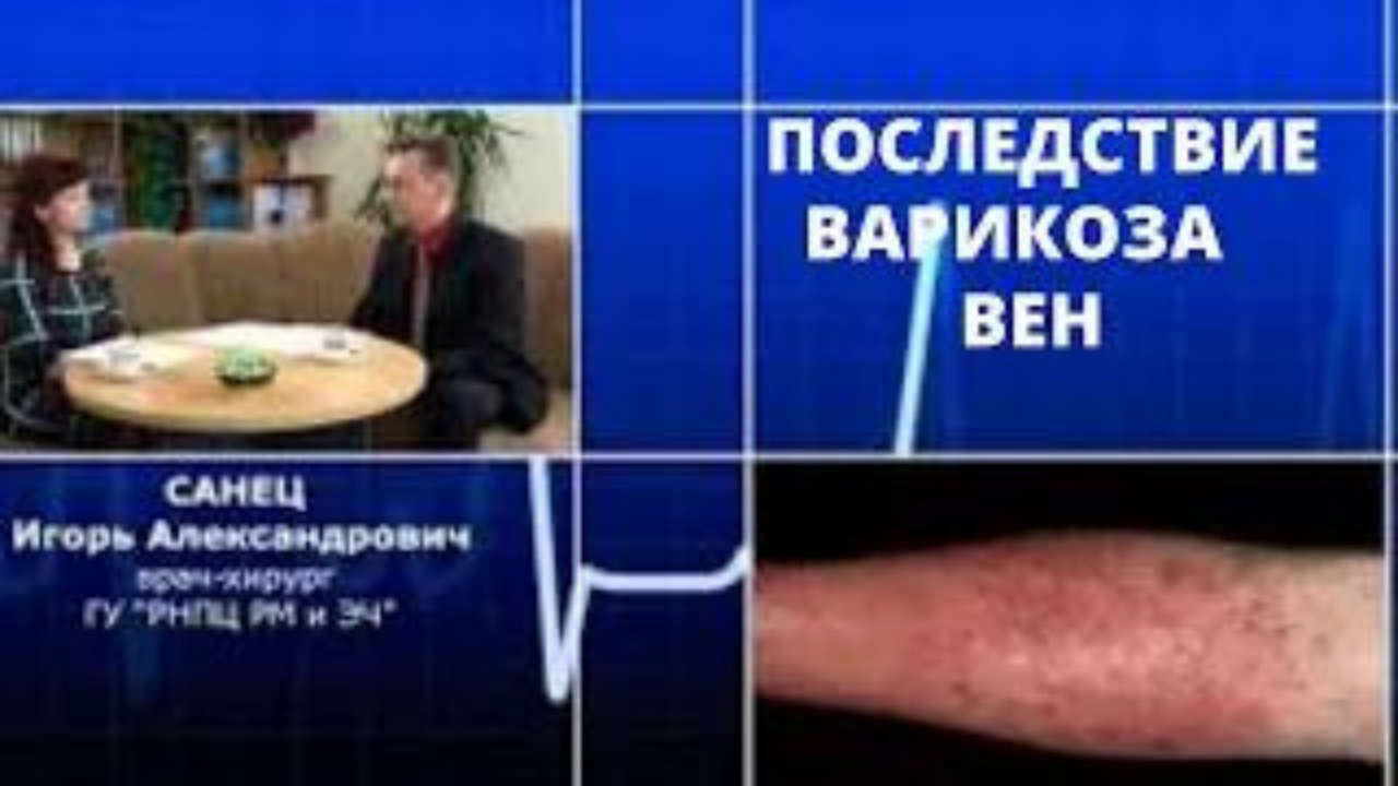 #варикоз вен,последствие.mp4