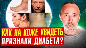 Ваша КОЖА точно укажет на Сахарный Диабет 2 типа! Причины и лечение диабета! Отличие 2 от 1 типа!