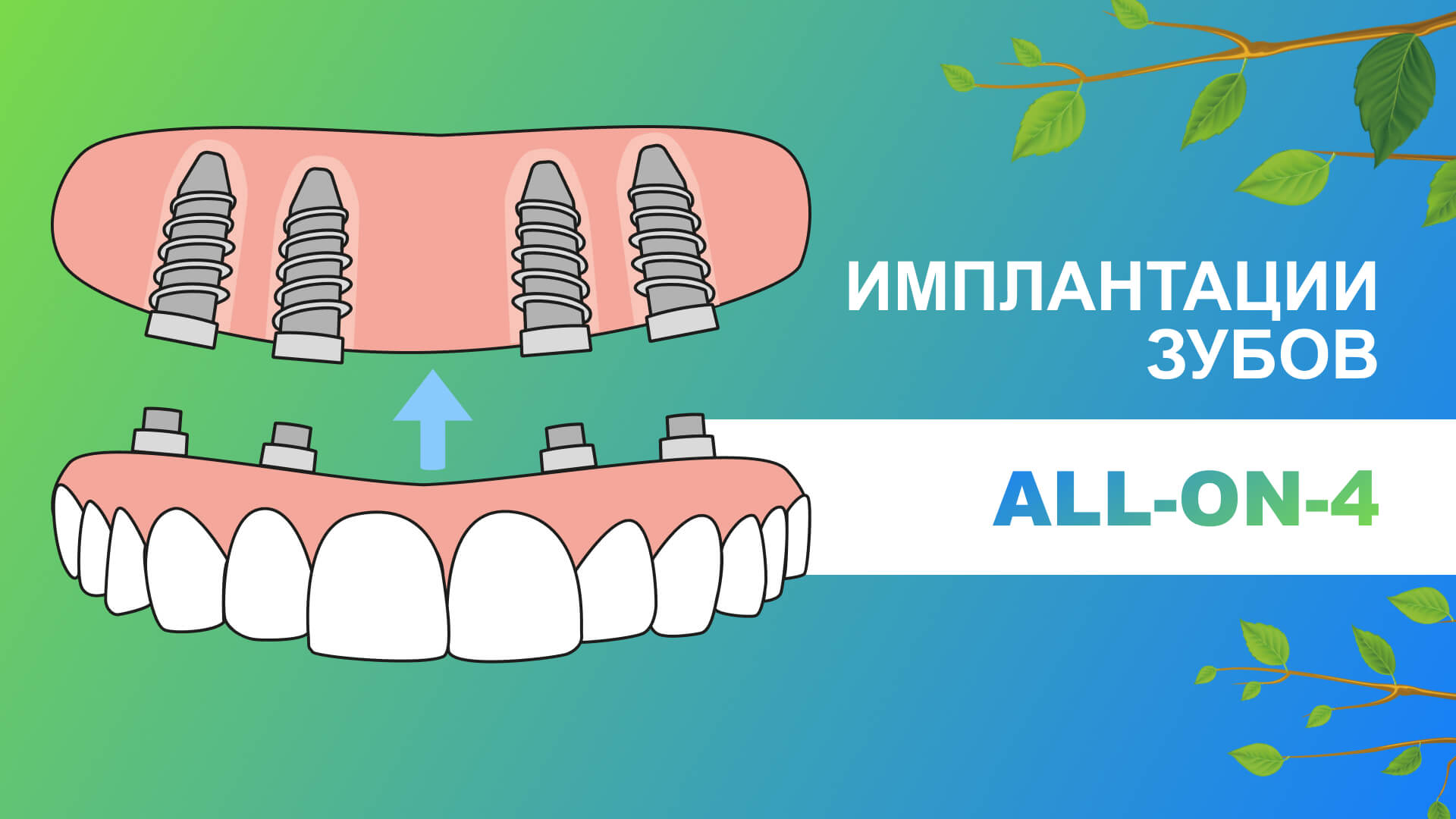 ? Имплантация зубов All-on-4 в загородной практике -Фамилия - (этапы, акции, цены)