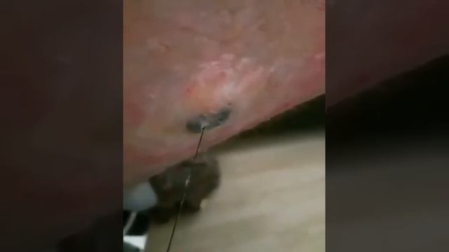 Достал вросший волос.