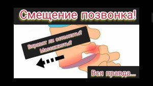 Смещение позвонка! Может ли вправить остеопат? Массажист? Тренер?/ Спондилолистез разбор МРТ