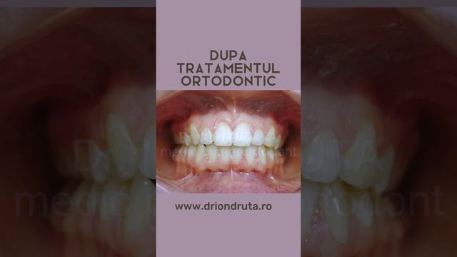 Caz rezolvat Dr. Ion Druta! #tratamentortodontic #aparatdentar #dintialiniaticorect #medicortodont