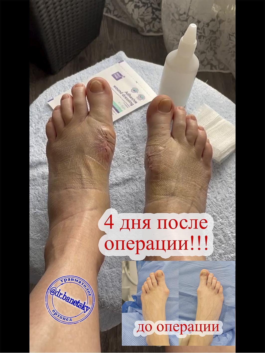 4е дня после операции перевязка. Малотравматичная методика смотреть ...