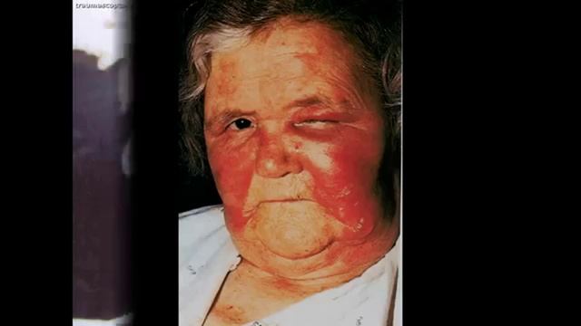 ШОК 10 ФОТО БОЛЕЗНЬ РОЖА смотреть онлайн