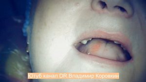 Применение аппарата Коппа на практике.  Удаление мостовидного протеза с целью экстракции зубов.#1.