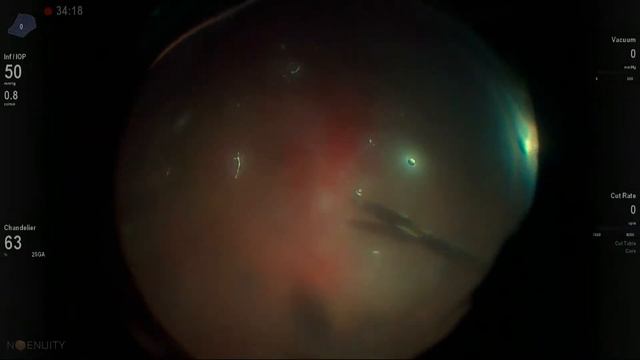 Bimanual Vitrectomy смотреть онлайн