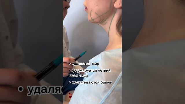 Что нужно знать про липосакцию подбородка?