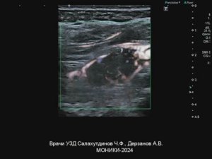 Хемодектома