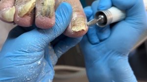 Онихогрифоз | обработка утолщенных ногтей | история клиента