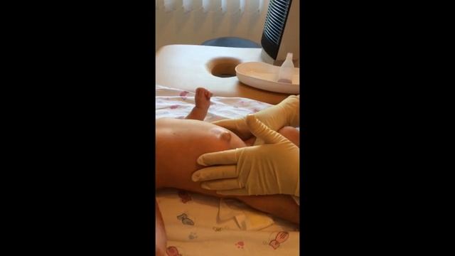 Пупочная грыжа у младенцев. Пупочная грыжа у новорожденного. Nabelbruch bei Babys.