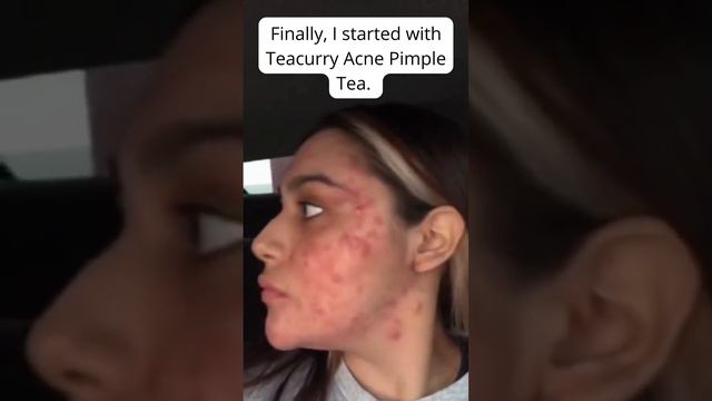 Wow My Face is to Clean - Teacurry Acne Pimple Tea #teacurry #acne #pimple #tea