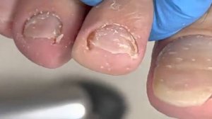 Huge ingrown nails on the front of toenails, clean and care【Xue Yidao Pedicure】