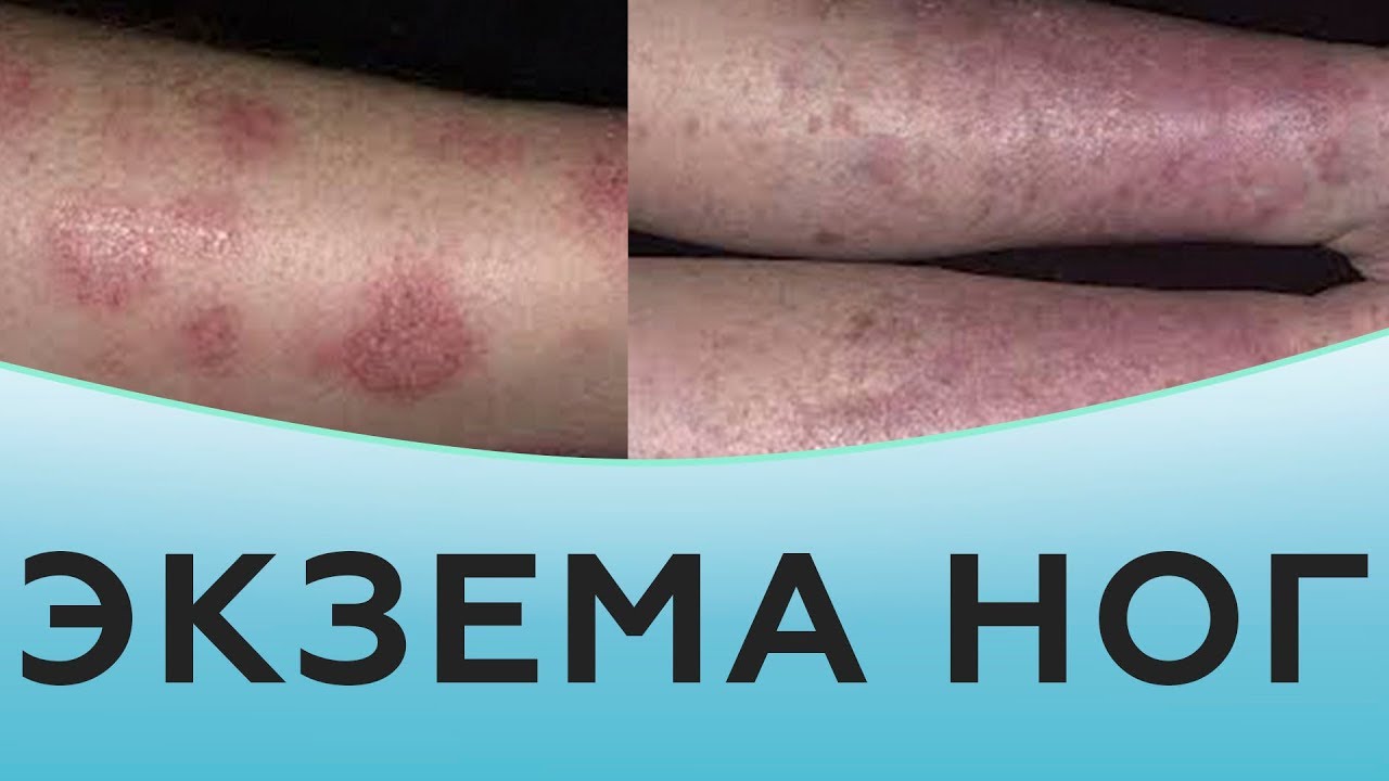 Экзема ног.