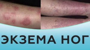 Экзема ног.