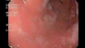 Полип желудка 2018 08 18