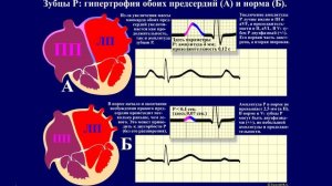 Тема 23.1. ЭКГ при гипертрофии камер сердца.