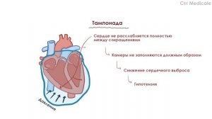 Тампонада сердца