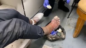 Молодой парень гниёт заживо. Жизнь Бездомного человека на улице. Последствия