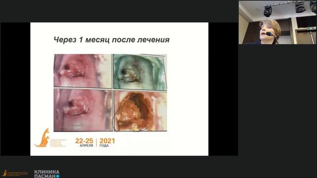 Веретельникова Т.В. Органосохраняющая тактика. Раком шейки 1 ст. VМеждународный конгресс 25.04 Зал смотреть онлайн