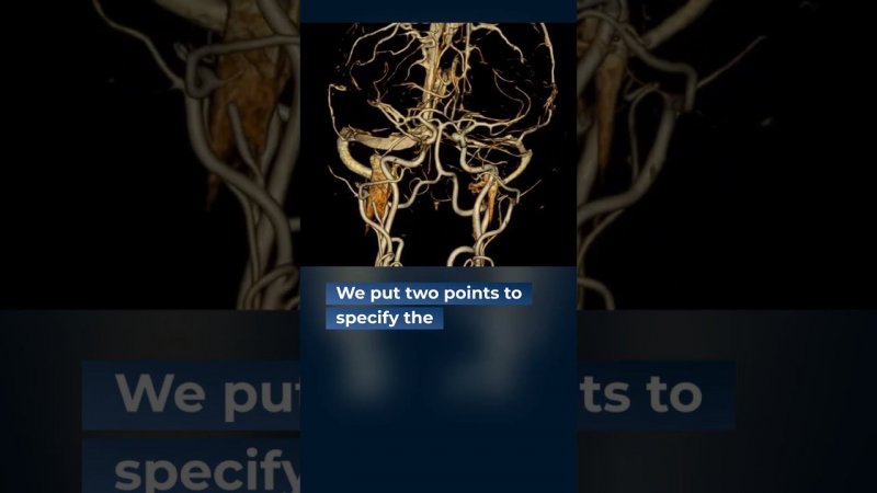 Let's analyze it. Saccular aneurysm