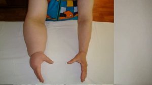 Застой лимфы и отёки: простыми словами. Лимфостаз и простые способы заботы о лимфатической системе.