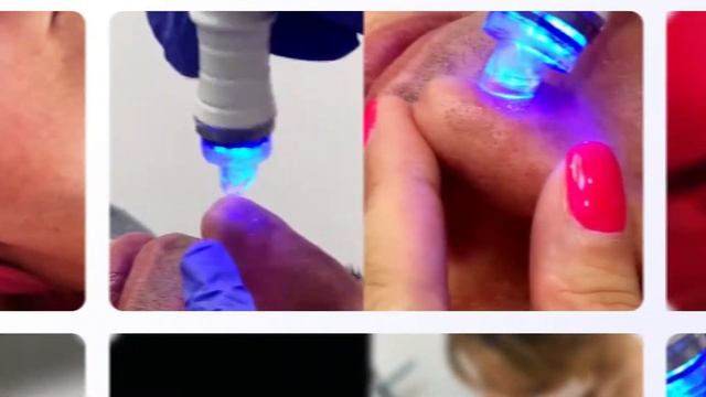 HYDRAPEEL FACIAL