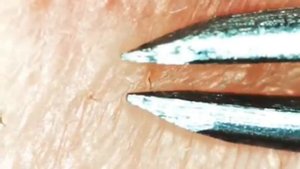 Специальные щипцы для очистки пор на коже лица  #5