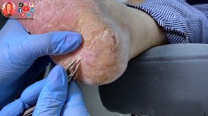 Трещины на пятках / Потрескалась кожа на ногах