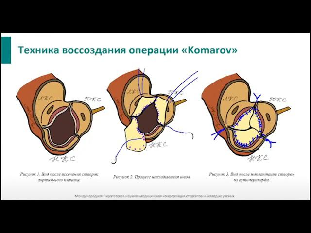 Возможно ли сохранить  нативную анатомию клапана корня аорты при его замене? Ответ ученых в видео!