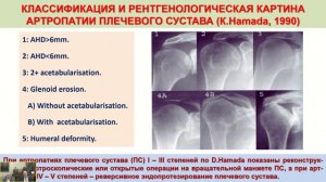 Современные возможности реконструктивных артроскопических операций в лечении пациентов...