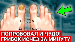 Намазал И ВОТ РЕЗУЛЬТАТ...Фантастика! Грибок СОШЕЛ на ГЛАЗАХ...