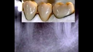 Металлокерамический мост  Как изготовить металлокерамический мост  Ортопедическая стоматология