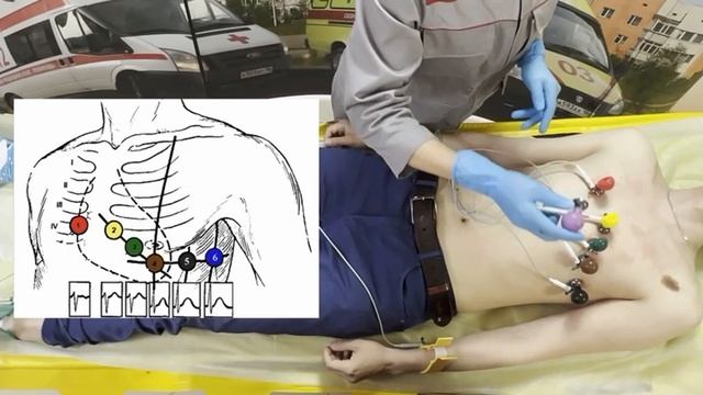Методика регистрации ЭКГ смотреть онлайн
