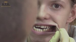 Реконструкция нижней и верхней челюсти.