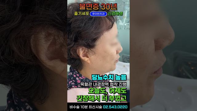 치매 증후 자가진단! 불면증 30년 얼굴부종(부기)😭귓볼주름 머리 멍한 브레인포그, 전신근육경직 아침에 눈뜨기 힘든 눈부종, 입마름 심한 침샘비대증 I  #루이빈치과 류지헌 원장