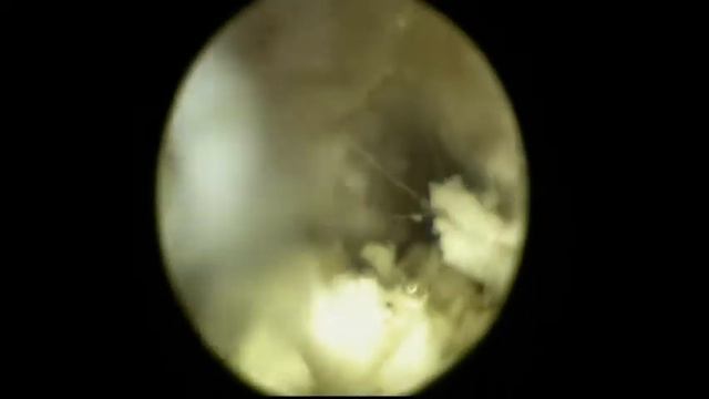 розрив барабанної перепонки смотреть онлайн