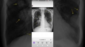 как выглядит рак на лёгких.🫁🫁🫁🦠🦠🦠