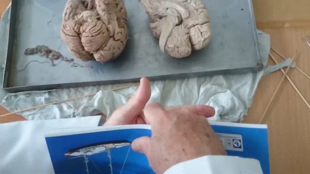 Задний мозг ,, мозжечок ,,ромбовидная ямка ,, мост мозга  MOV 2528